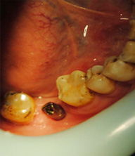 种植牙手术过程步骤二
