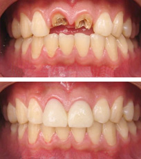 多颗牙缺失种植前后对比