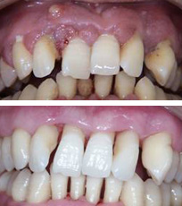 牙周脓肿治疗前后对比